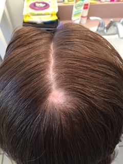 8 year old girl with Alopecia (hair loss) and anxiety related to (suspected) PANDAS, resolved with homeopathy (must see photos!)